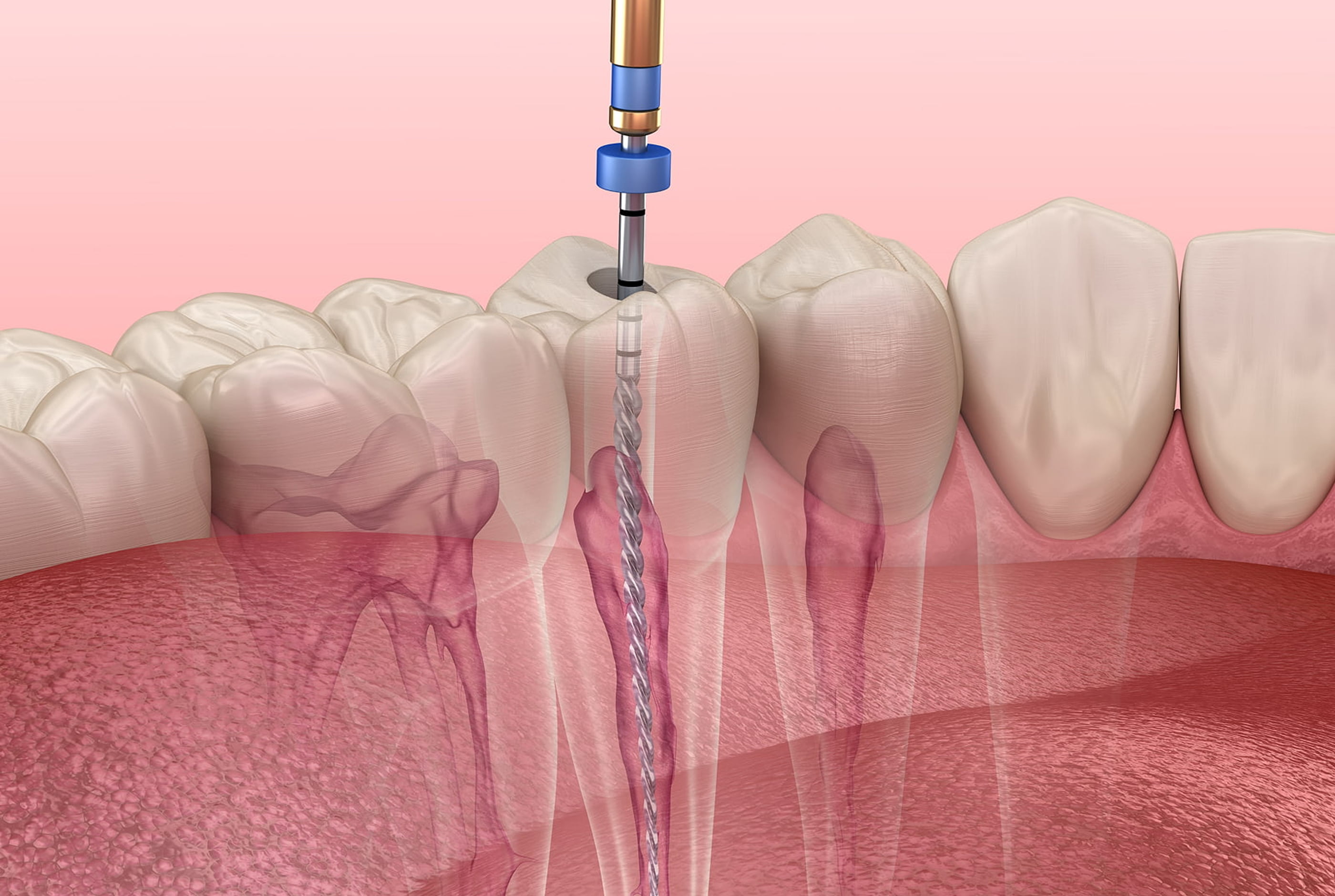 Root canal treatment at Pure Arts Dental Care