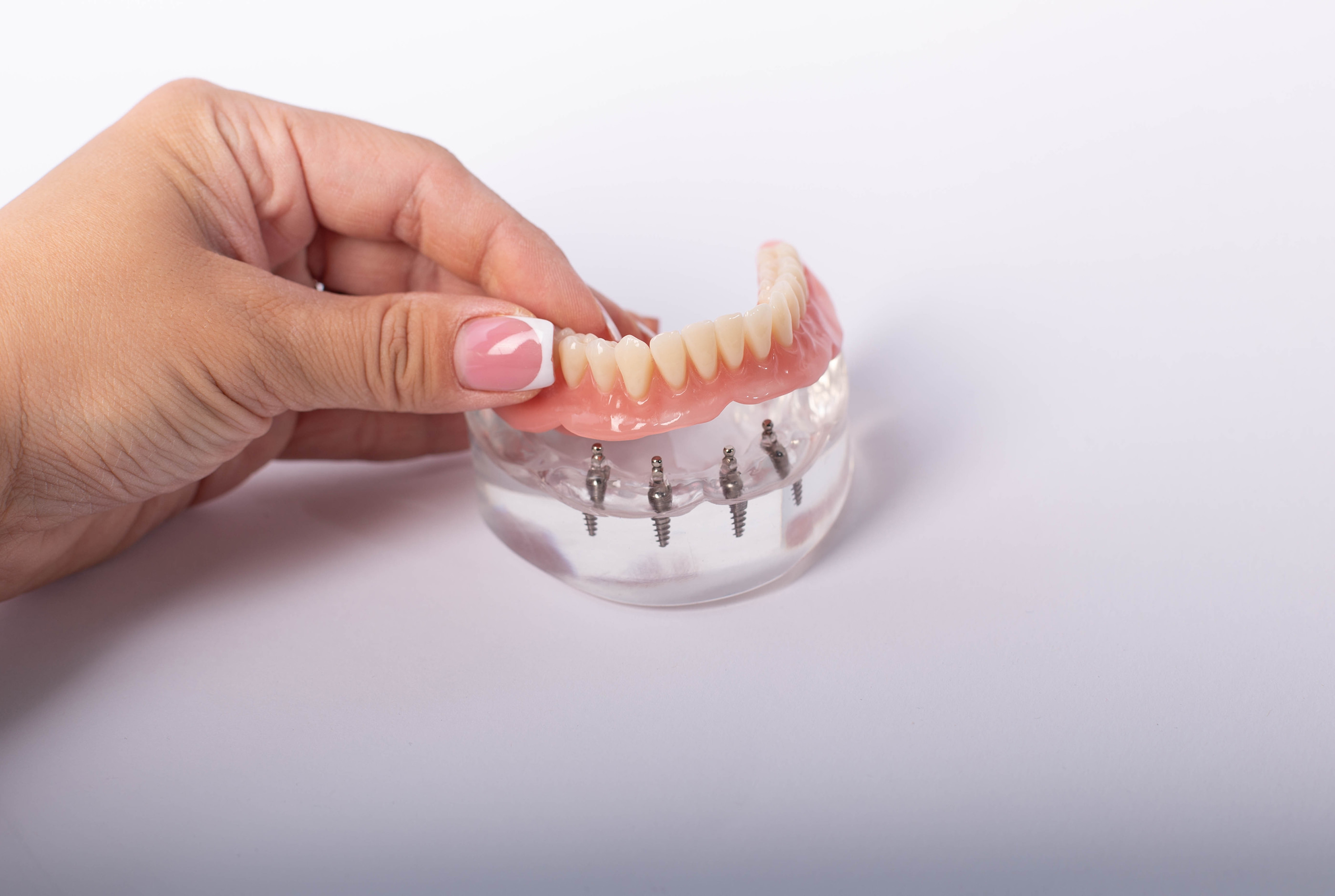 All-on-4 dental implants at Pure Arts Dental Care