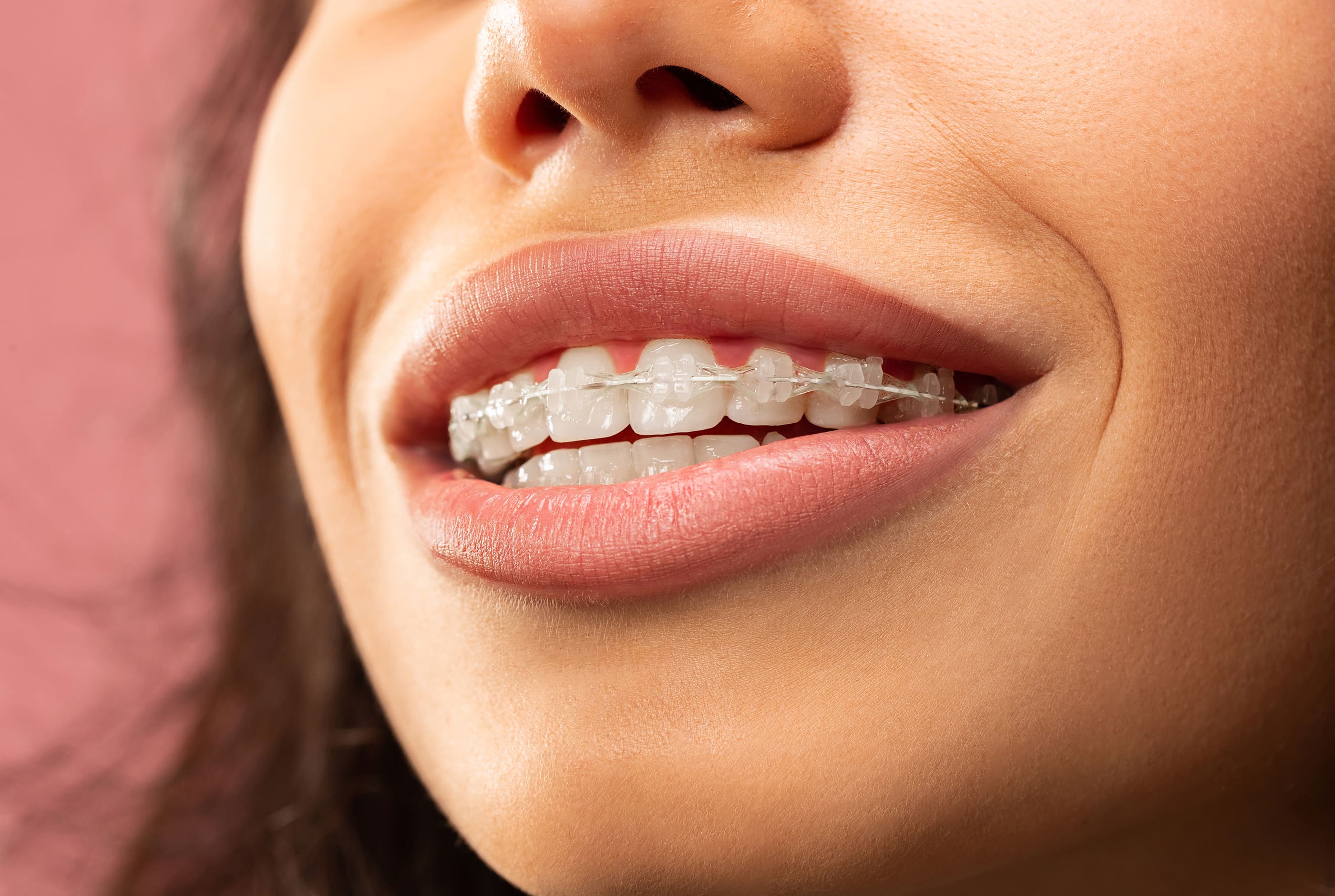 Clear braces for discreet orthodontics at Pure Arts