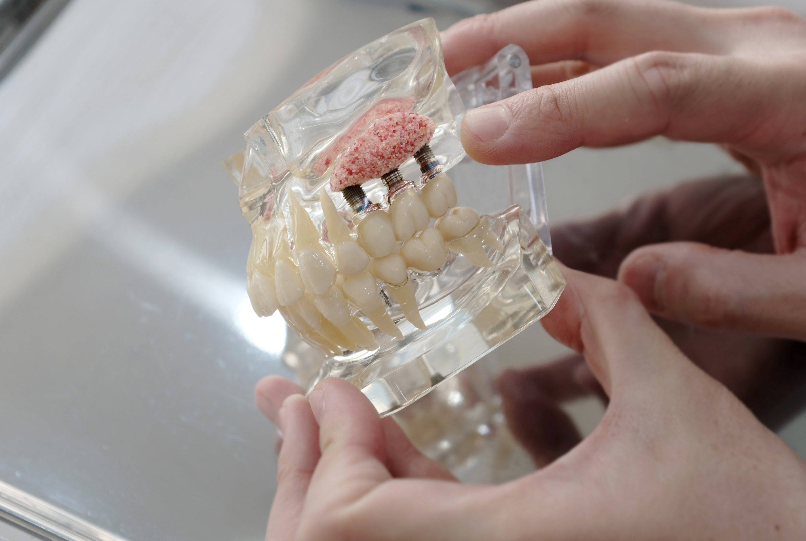 Importance of jawbone for dental implants at Pure Arts