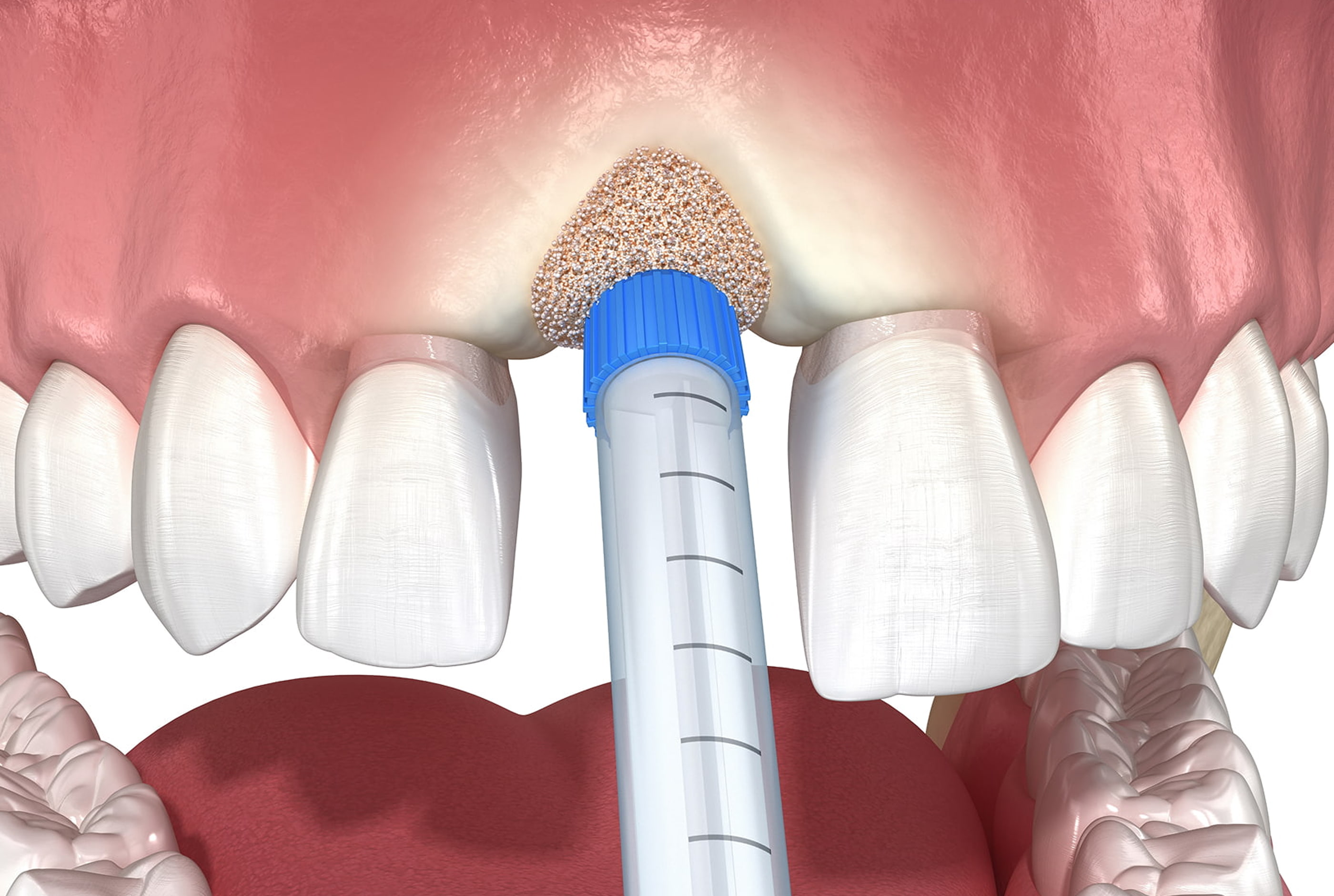 Bone grafting for dental implants at Pure Arts