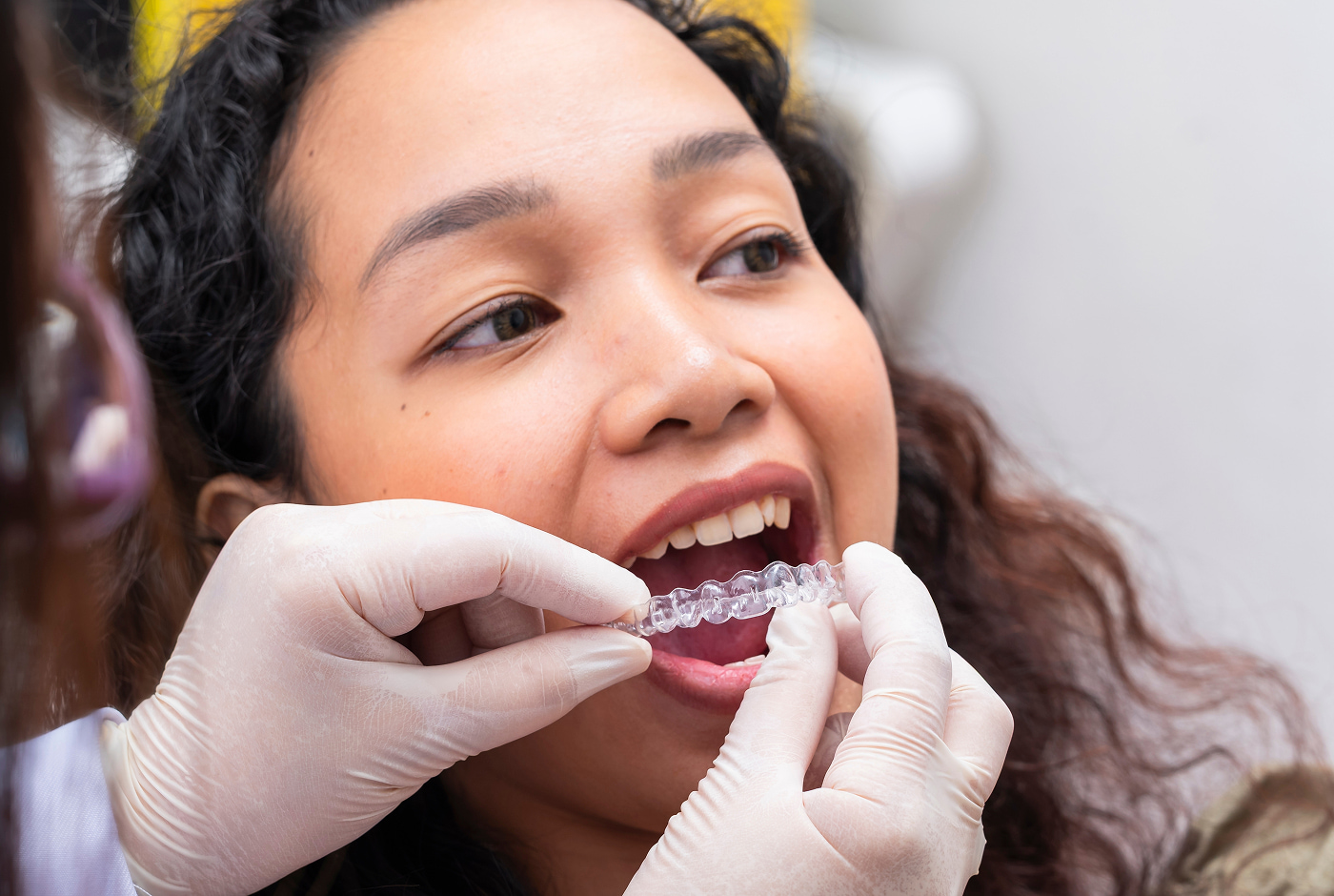 Clear aligners vs braces at Pure Arts