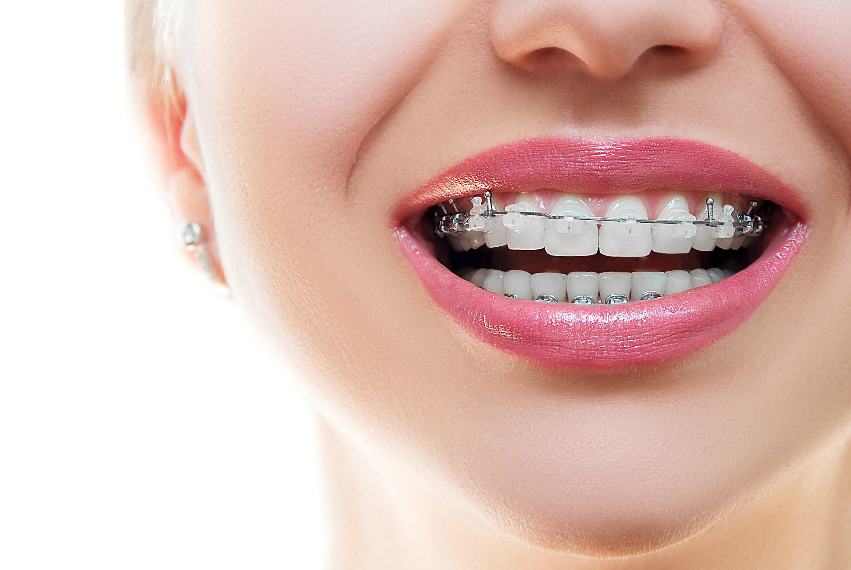 Clear braces for discreet orthodontic treatment at Pure Arts