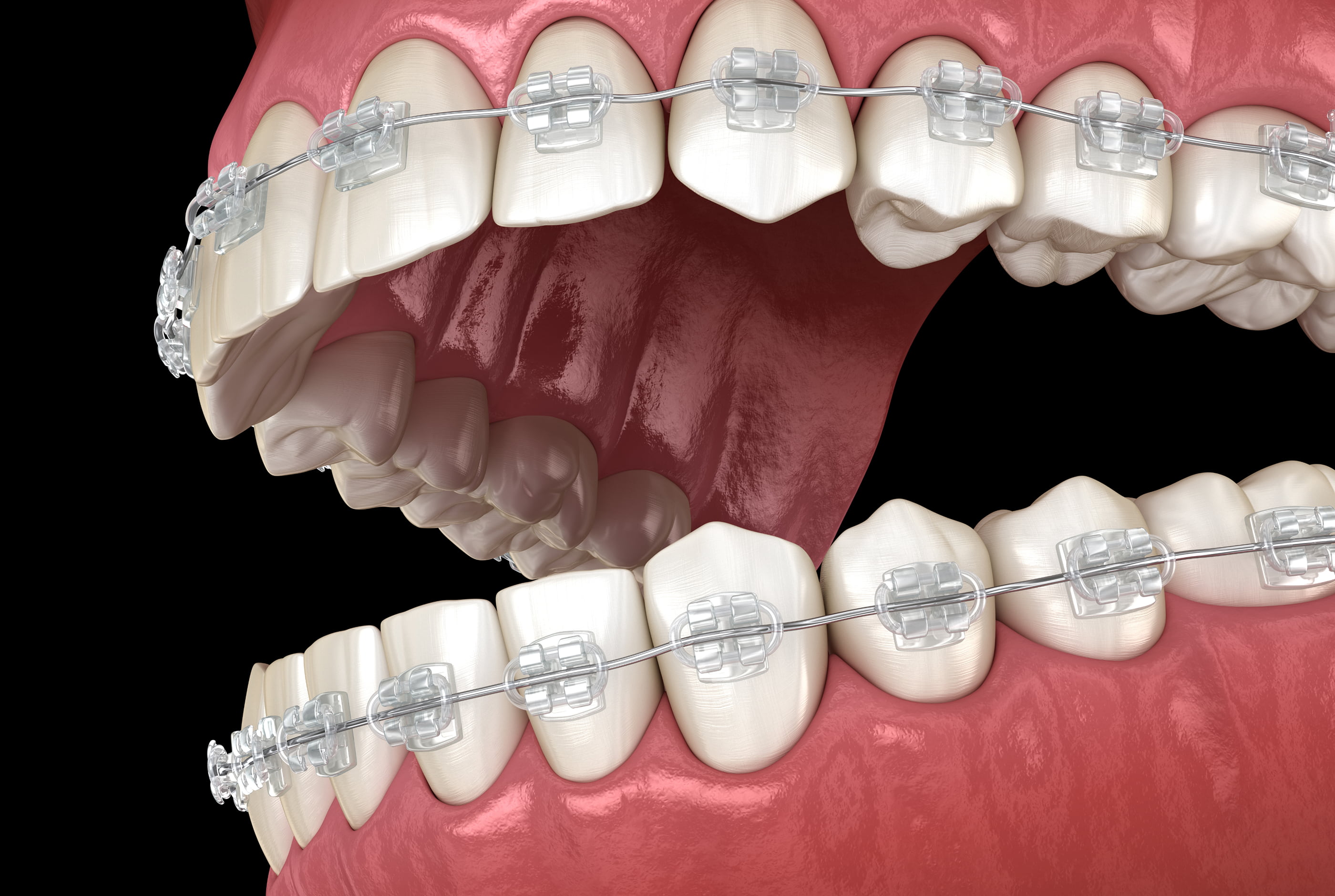 Clear braces candidates at Pure Arts