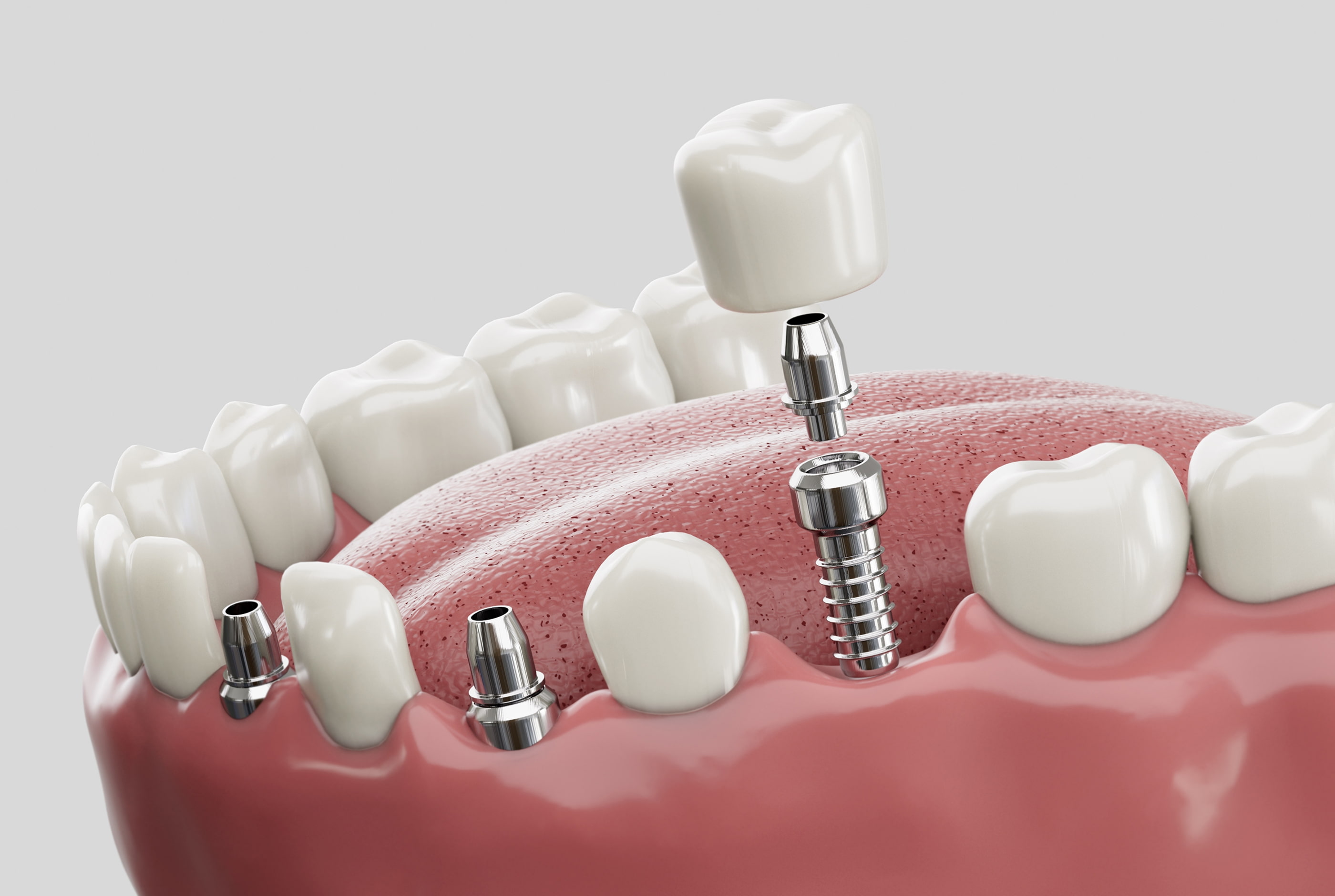 Dental implants for tooth replacement at Pure Arts Dental Care