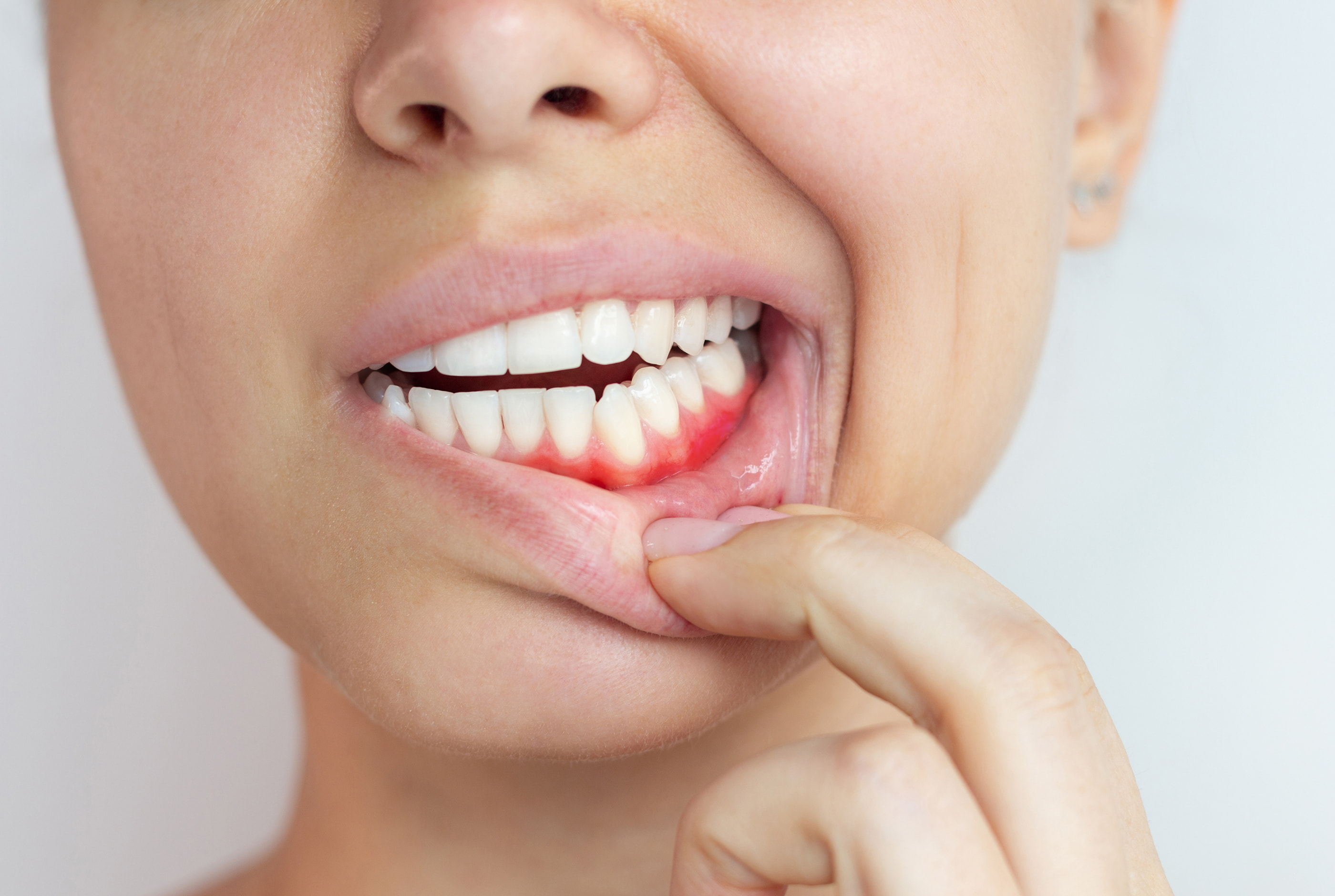 Bleeding gums caused by gingivitis and early gum disease