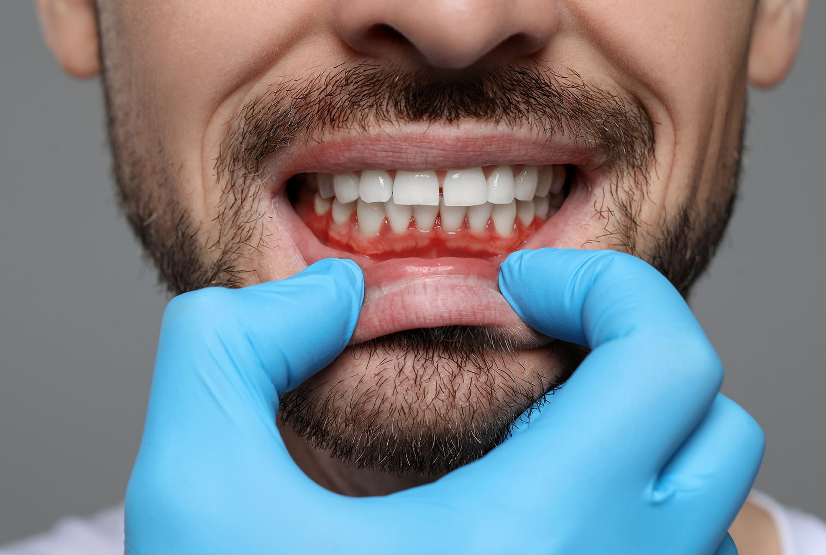 Gum recession causes and risks at Pure Arts