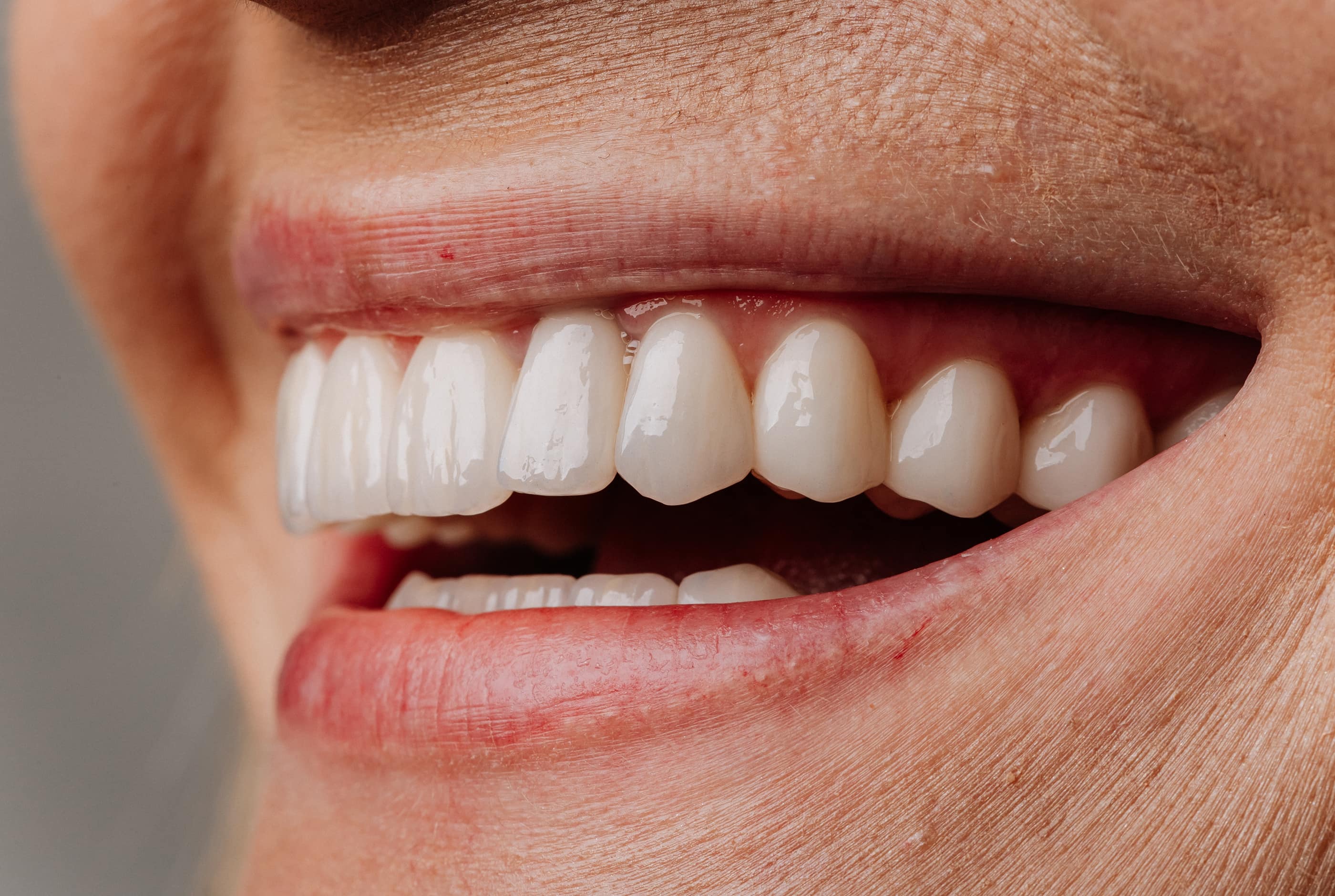 Importance of treating gum recession at Pure Arts