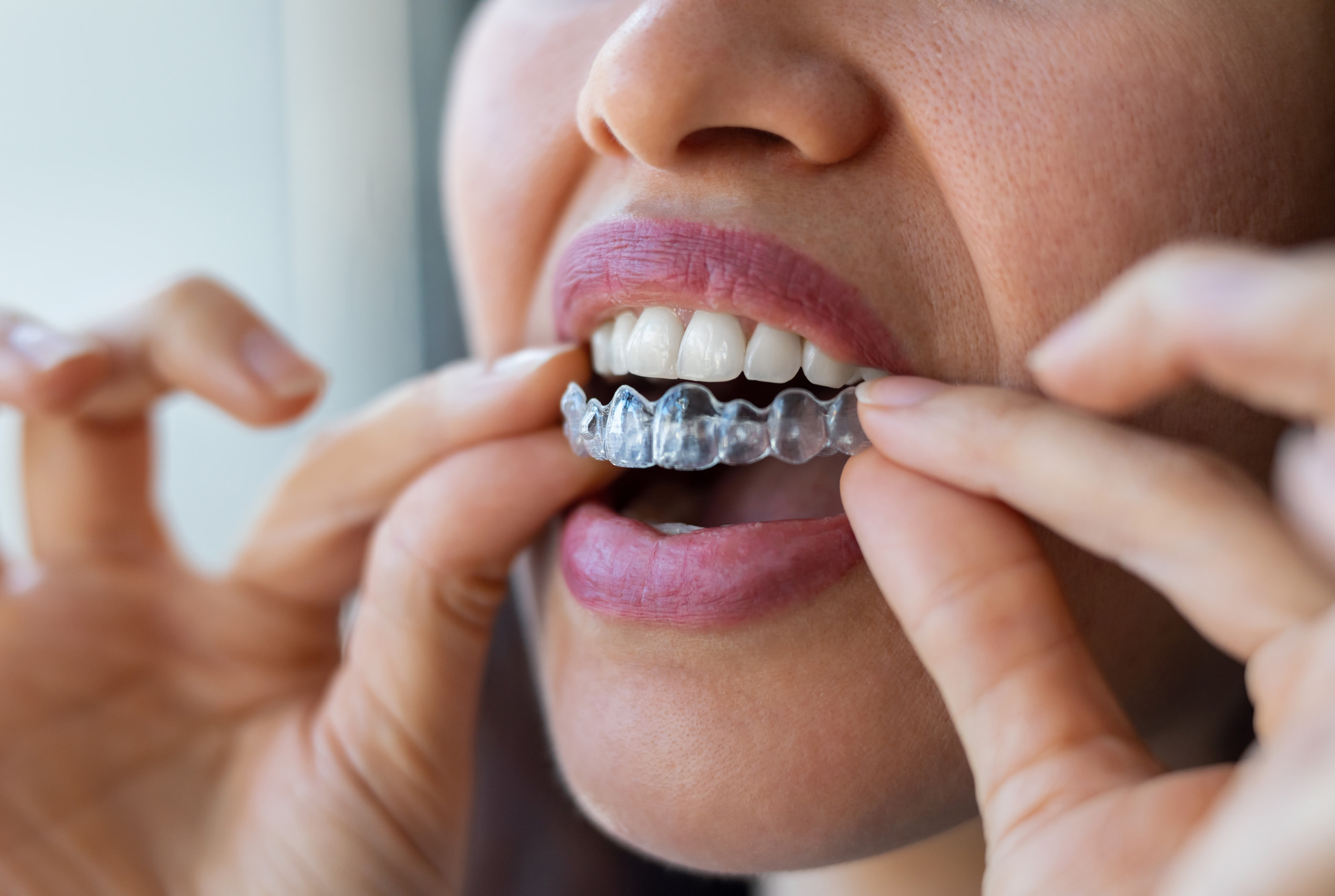 Invisalign treatment for crowding and bite correction at Pure Arts