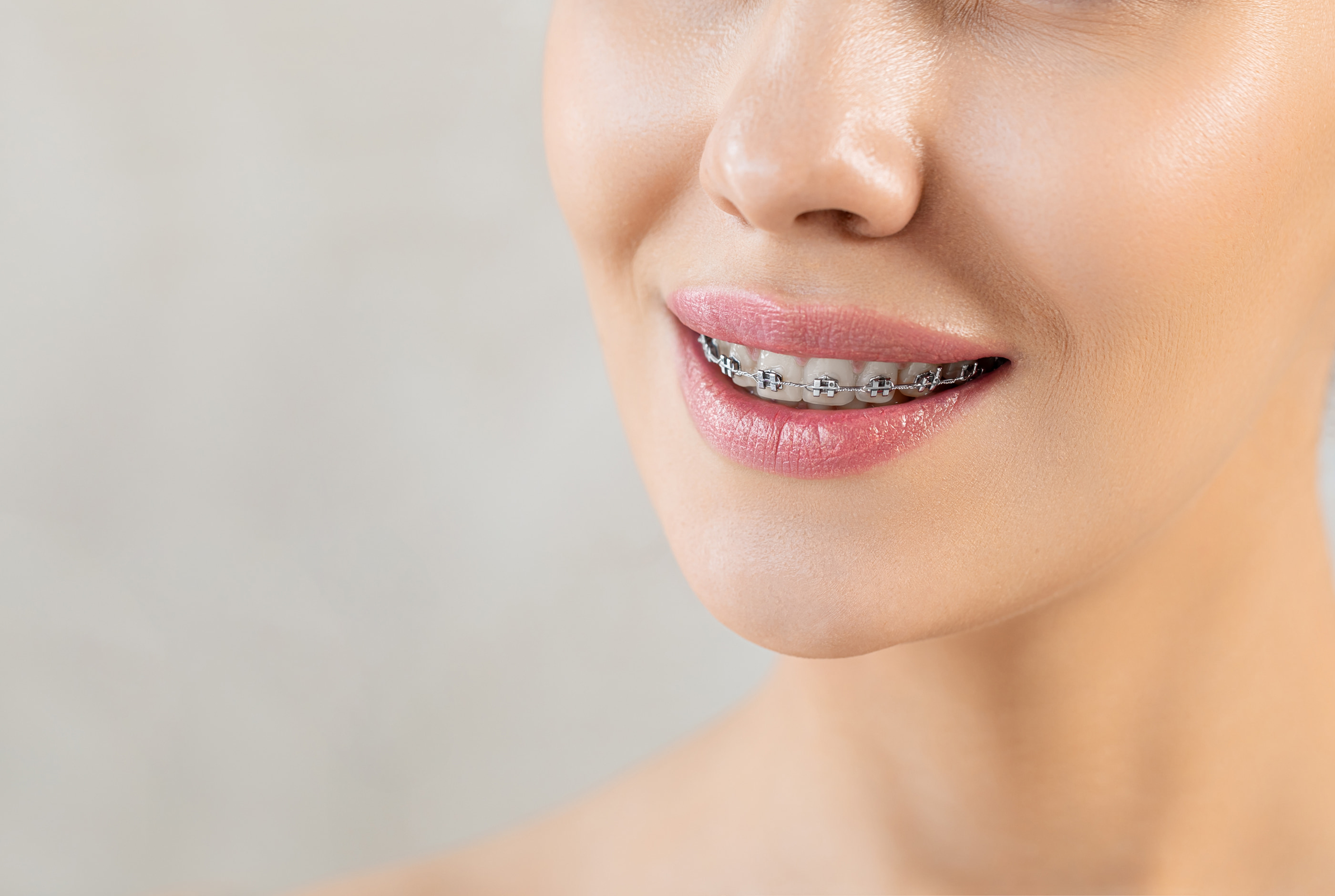 Traditional braces for complex orthodontic correction at Pure Arts