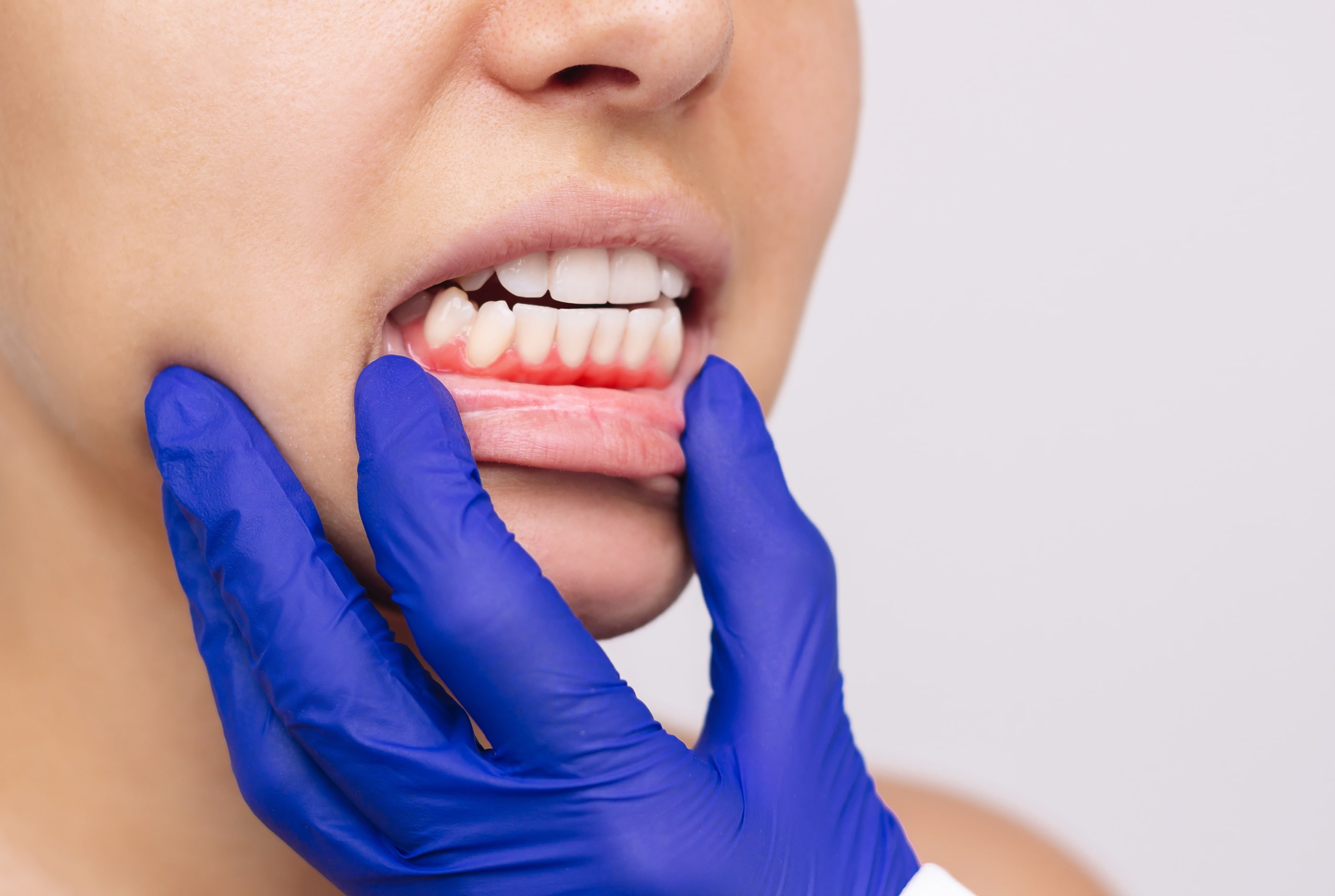 Gum disease treatment with LANAP at Pure Arts