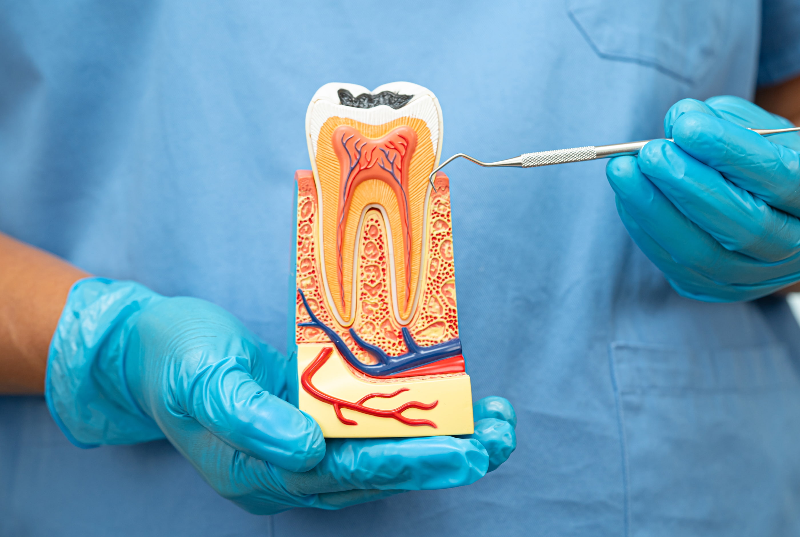 Signs you need a root canal treatment