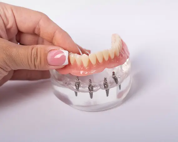 All-on-4 Implants