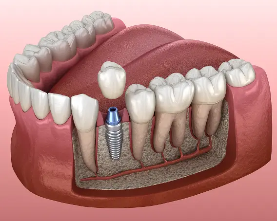 Single Dental Implants