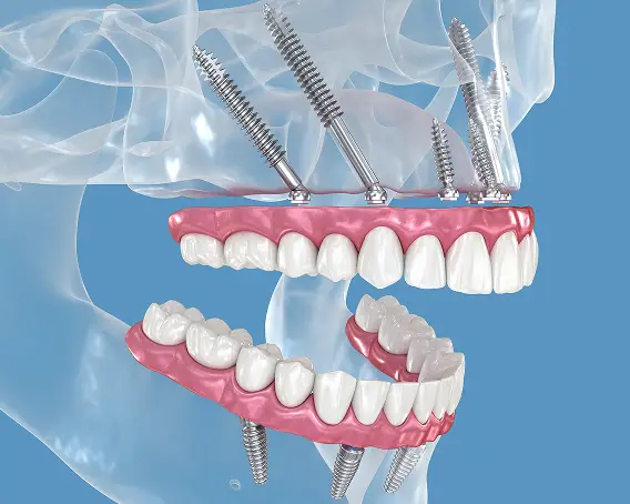 Zygomatic (No Bone) Dental Implants