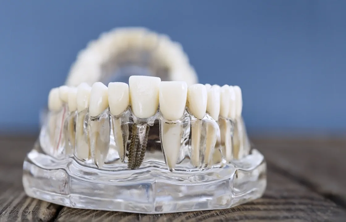 Affordable Dentures Rego Park NY — Comfortable, Modern Tooth Replacement Options Near You