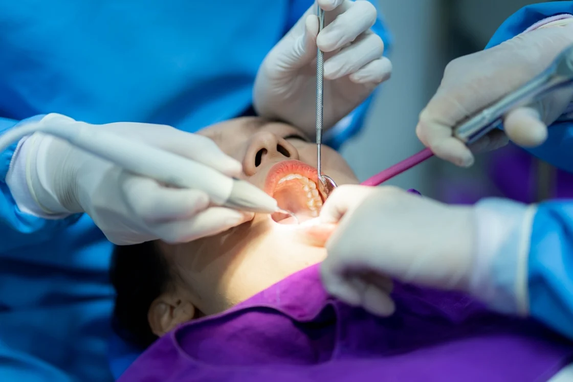 Wisdom Teeth Removal